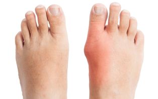 home remedies for gout